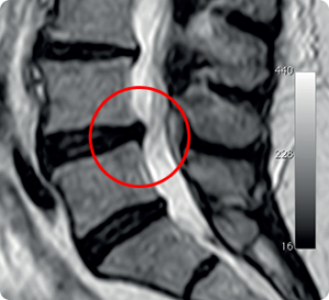 Solution Medical – DISKOM – Percutaneous Discectomy Probe